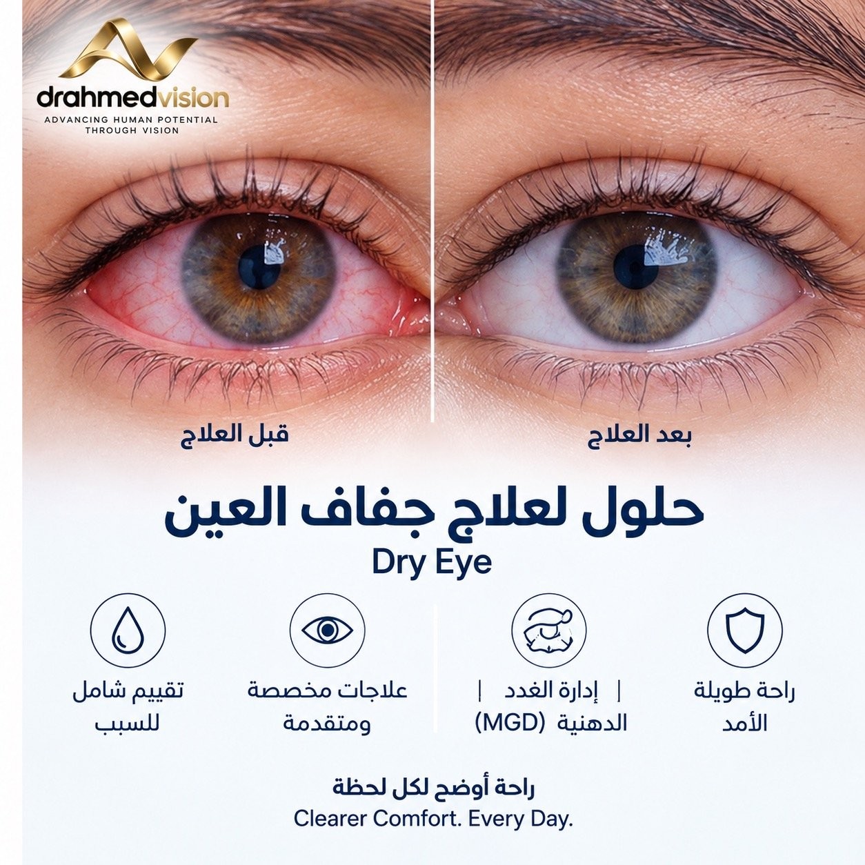 جفاف العين